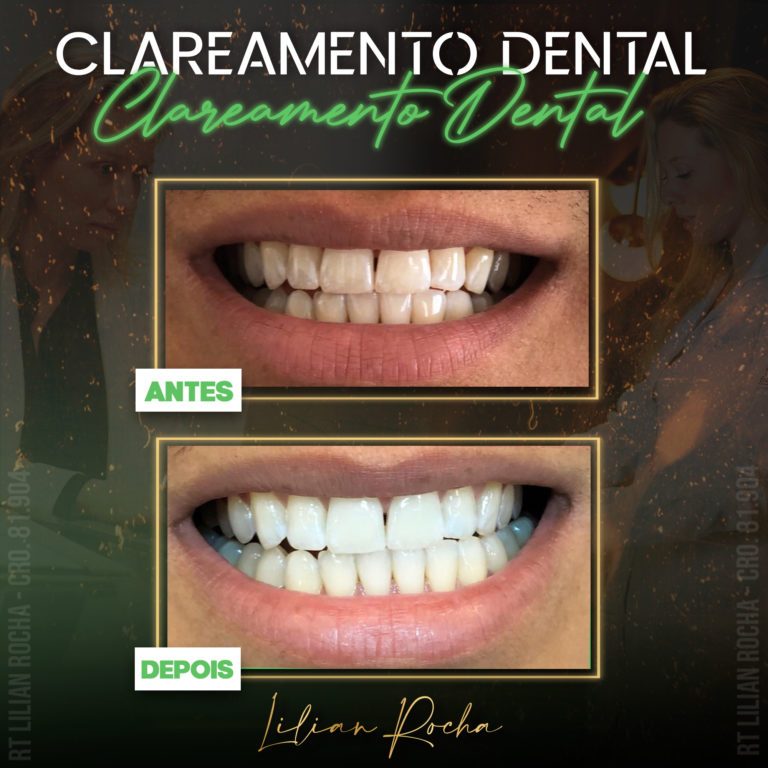 antes e depois lilian 1