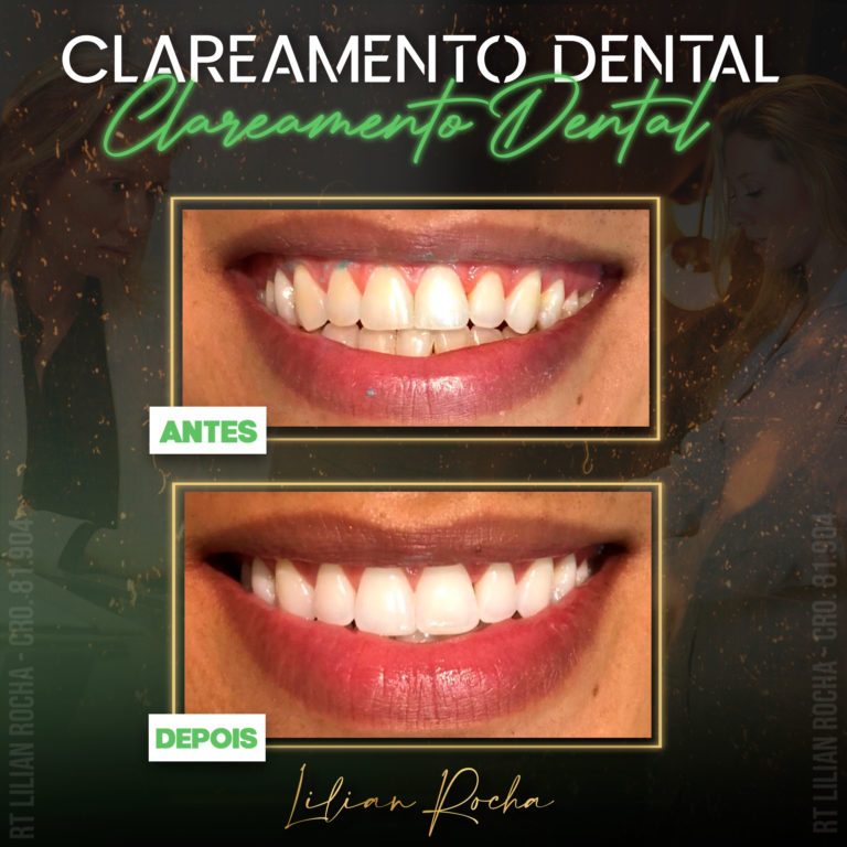 antes e depois lilian 2