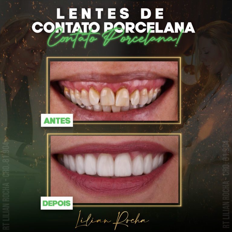 antes e depois lilian